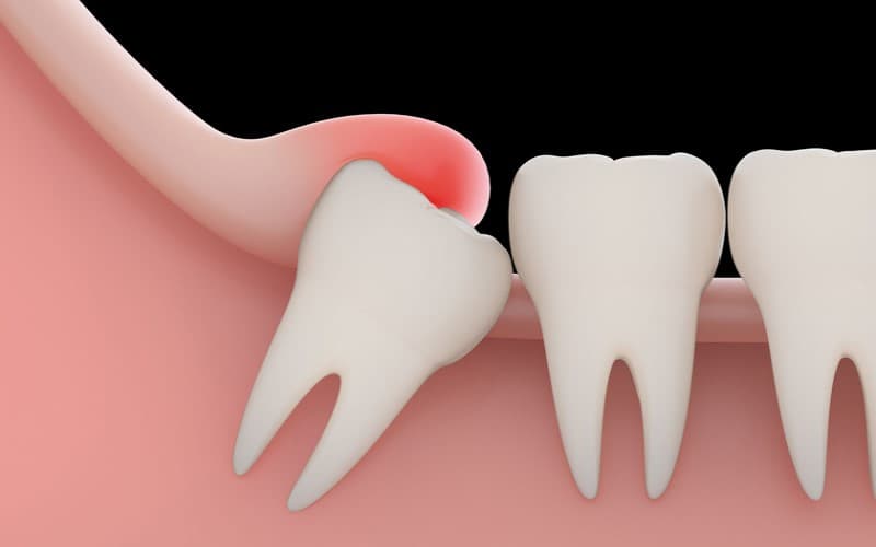 Cơn đau răng nào cảnh báo bạn cần gặp nha sĩ