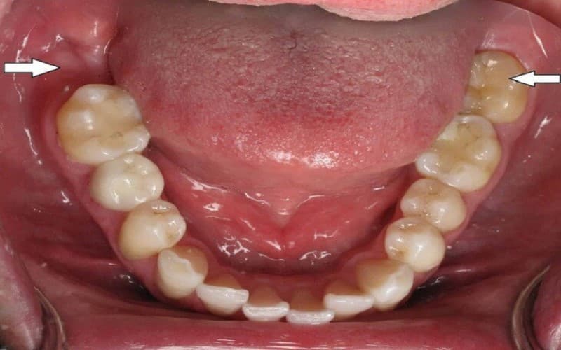 Hậu quả nghiêm trọng khi mất răng số 7