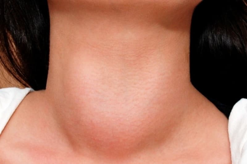 Tuyến giáp có thể tăng kích thước và tạo thành bướu vùng trước cổ