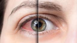 Hội chứng khô mắt: Nguyên nhân, triệu chứng và chăm sóc