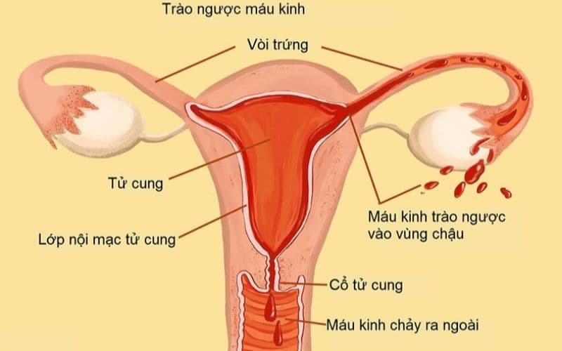 Lạc nội mạc tử cung