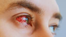 Loét giác mạc: Nguyên nhân, triệu chứng, điều trị và phòng ngừa