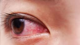 Mắt đỏ 1 bên: Nguyên nhân, cách điều trị và phòng ngừa