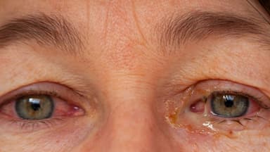 Mắt đỏ có ghèn có nguy hiểm không? Nguyên nhân và cách điều trị