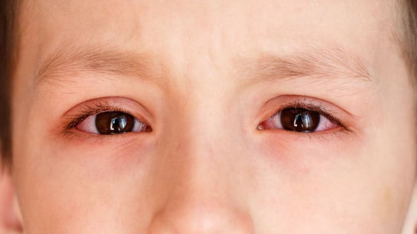 Mắt mờ sau khi đau mắt đỏ: Nguyên nhân & cách xử lý