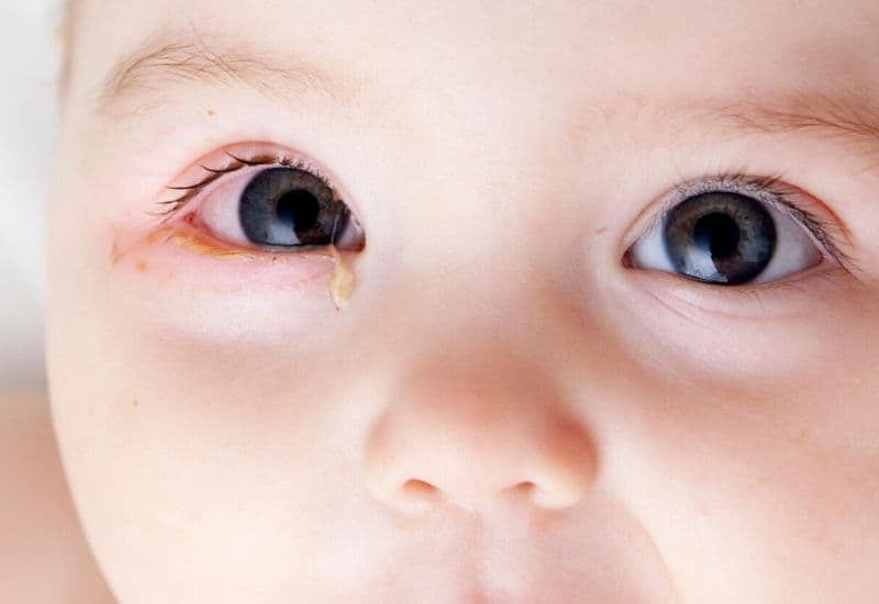 mắt sưng đỏ và đau