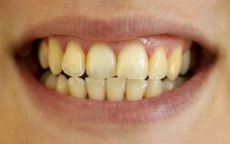 Tại sao răng bị ố vàng, xỉn màu
