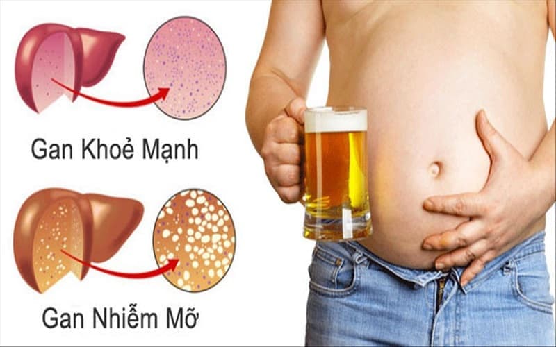 Rượu bia, thừa cân và chế độ ăn uống không lành mạnh có thể gây bệnh gan mật
