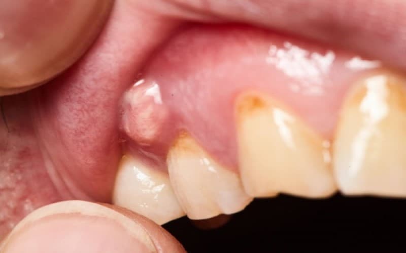 Nguyên nhân gây đau răng phổ biến