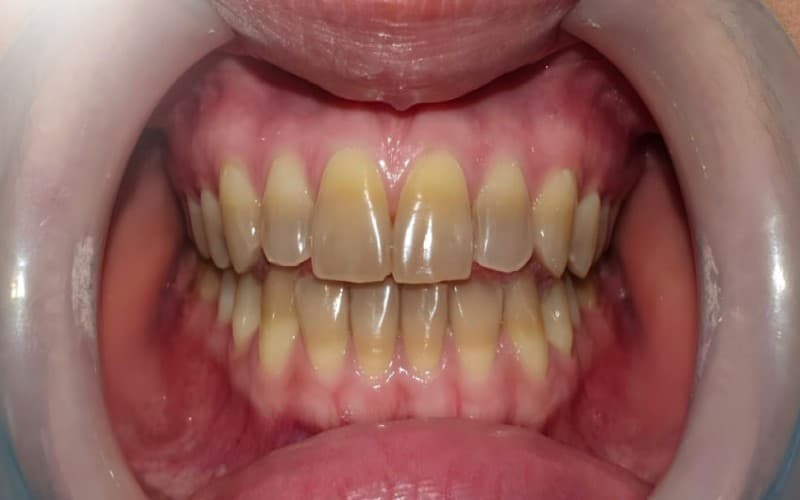 Nguyên nhân khiến răng bị xỉn màu