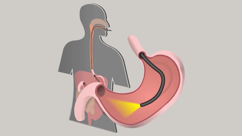 Nội soi tiêu hóa không phải lúc nào cũng gây đau, nhưng mức độ khó chịu có thể khác nhau tùy vị trí nội soi