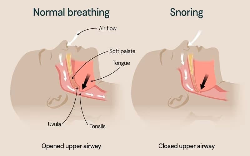 Mô mềm vùng họng rung hoặc xẹp xuống khi ngủ có thể làm thu hẹp đường thở và gây ngáy.