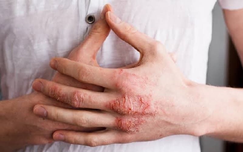 Bệnh da liễu có thể gây ảnh hưởng đến làn da và sinh hoạt hằng ngày. 