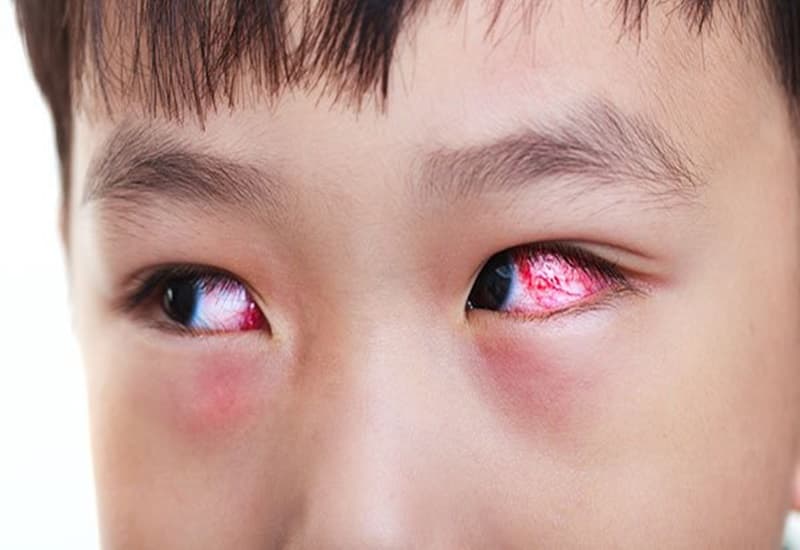 Đỏ mắt, cộm xốn hoặc chảy nước mắt nhiều có thể xuất phát từ nhiều nguyên nhân khác nhau