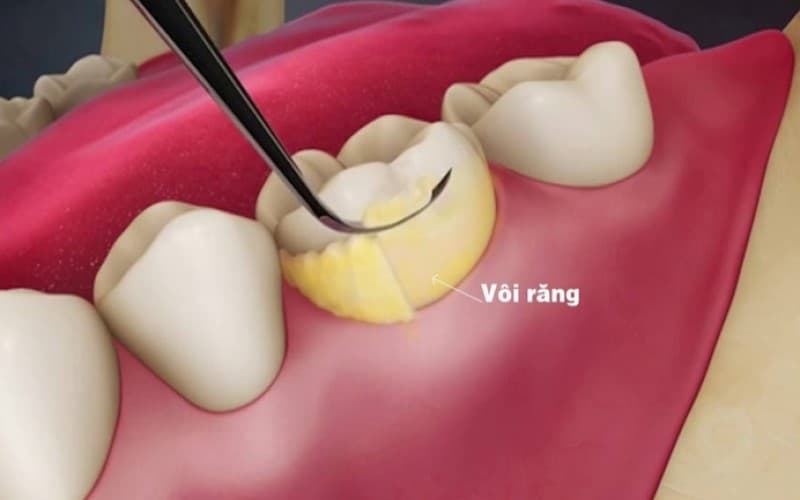Quy trình cạo vôi răng chuyên nghiệp