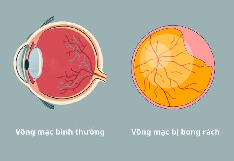 rách võng mạc