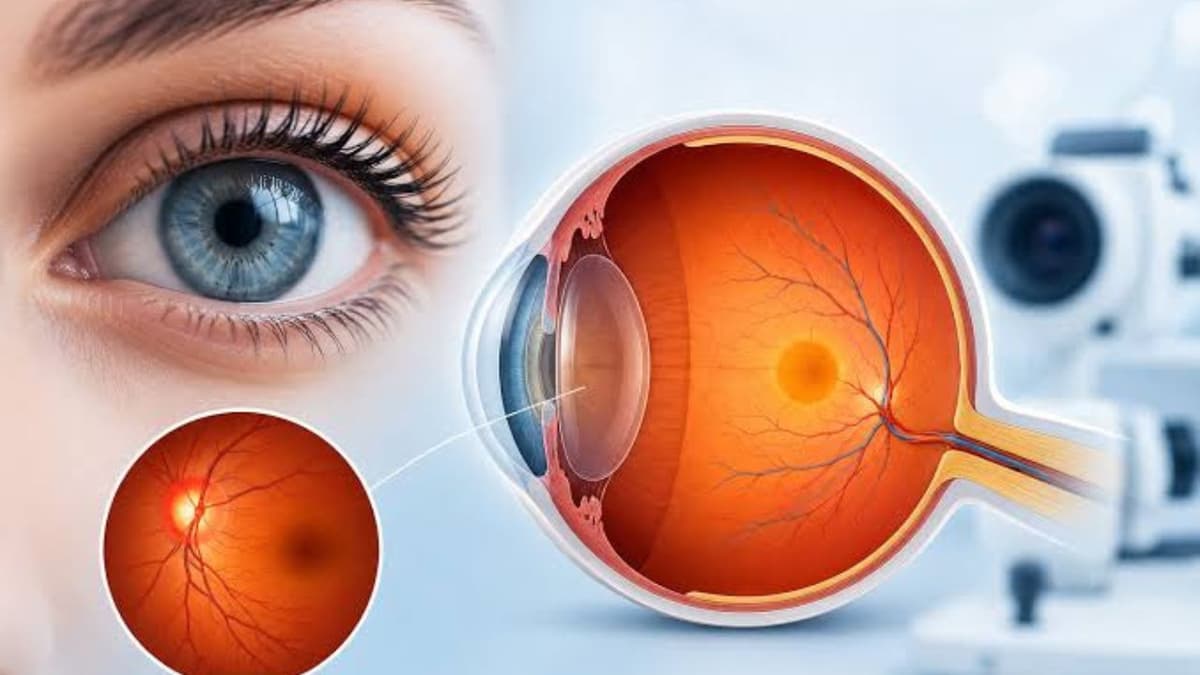 Rách võng mạc: Dấu hiệu nhận biết sớm, nguyên nhân và giải pháp điều trị hiệu quả