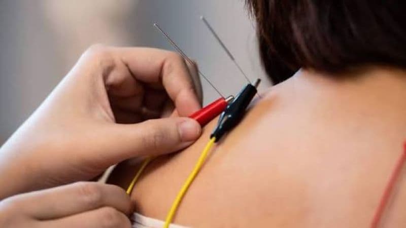Điện châm là phương pháp đưa kim vào các huyệt được lựa chọn, sau đó kết nối với thiết bị tạo dòng điện có cường độ phù hợp để kích thích huyệt