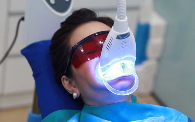 Tẩy trắng răng nha khoa chuyên sâu
