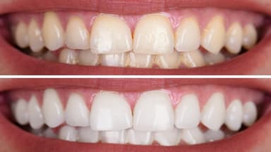 Tẩy trắng răng: Bí quyết sở hữu nụ cười trắng sáng toàn diện