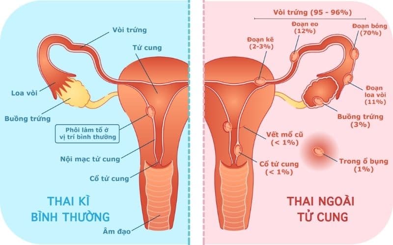 Thai ngoài tử cung