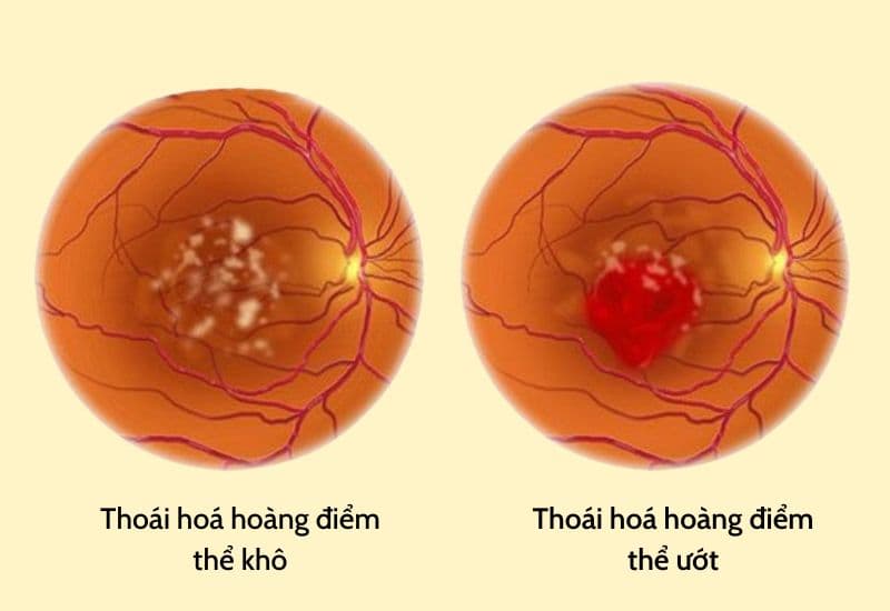 thoái hóa hoàng điểm