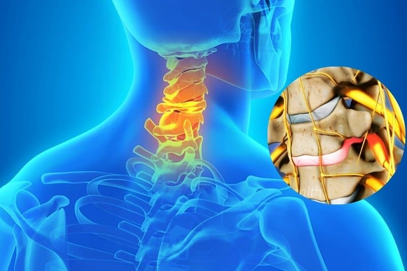 Thoát vị đĩa đệm cột sống cổ khiến nhân nhầy thoát ra ngoài làm đĩa đệm đè lên thần kinh và gây ra đau buốt