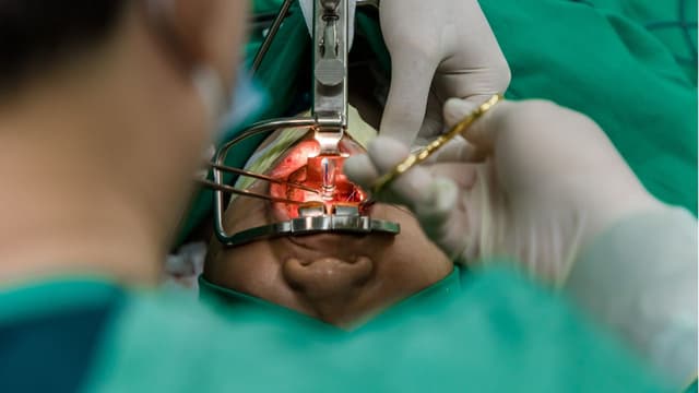 Phẫu thuật màn hầu lưỡi gà: Giải pháp vàng cho người ngưng thở khi ngủ và ngáy ngủ