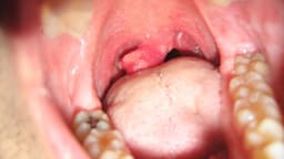 Cắt lưỡi gà có sao không và lúc nào cần thiết, các biến chứng tiềm ẩn