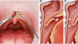 Phẫu thuật chỉnh hình màn hầu lưỡi gà (UPPP) là giải pháp toàn diện cho chứng ngưng thở khi ngủ