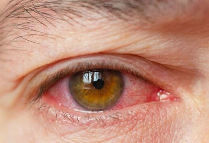 trầy xước giác mạc