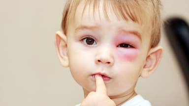 Trẻ bị đỏ mắt chảy ghèn: Dấu hiệu, nguyên nhân và cách chăm sóc