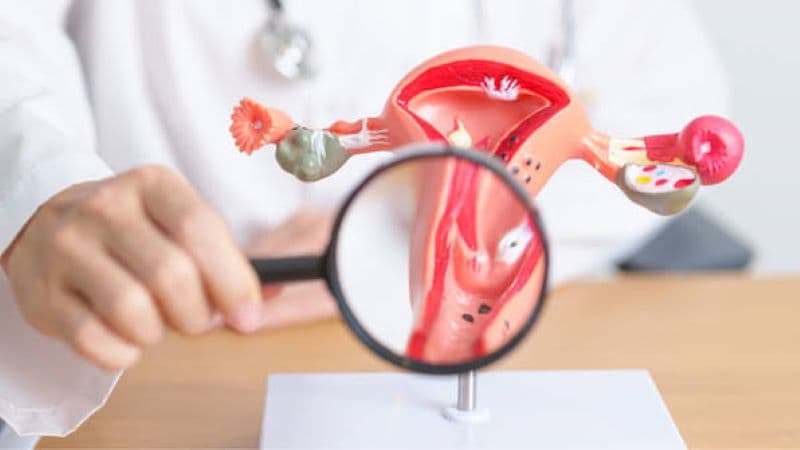 Viêm cổ tử cung là tình trạng cổ tử cung bị viêm do nhiều nguyên nhân như vi khuẩn, virus, nấm hoặc các tác nhân lây truyền qua đường tình dục