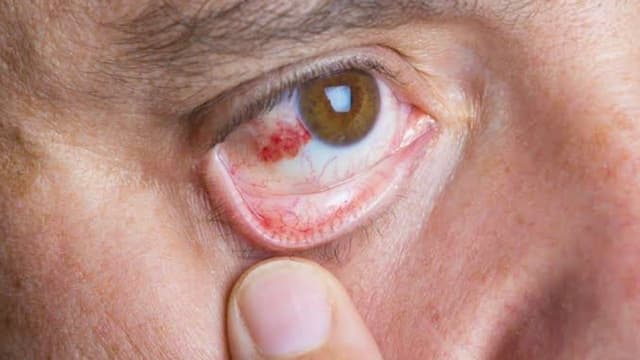 Viêm củng mạc: Nguyên nhân, triệu chứng và cách điều trị