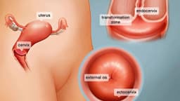 Viêm lộ tuyến cổ tử cung – Triệu chứng,cấp độ, điều trị