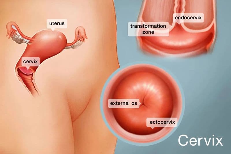 Lộ tuyến hình thành khi tế bào tuyến trong ống cổ tử cung phát triển ra bề mặt ngoài và có thể bị viêm nhiễm.