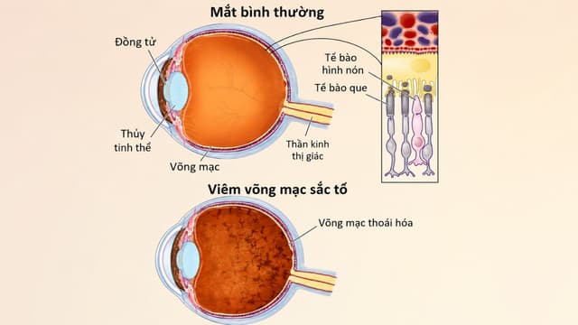 Viêm võng mạc sắc tố: Nguyên nhân, dấu hiệu và điều trị