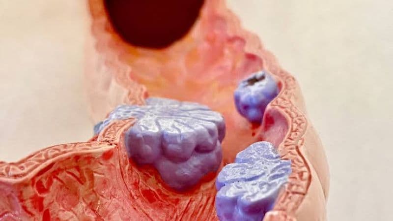 Xoắn polyp là thủ thuật ít xâm lấn, thường phù hợp với polyp có cuống rõ.