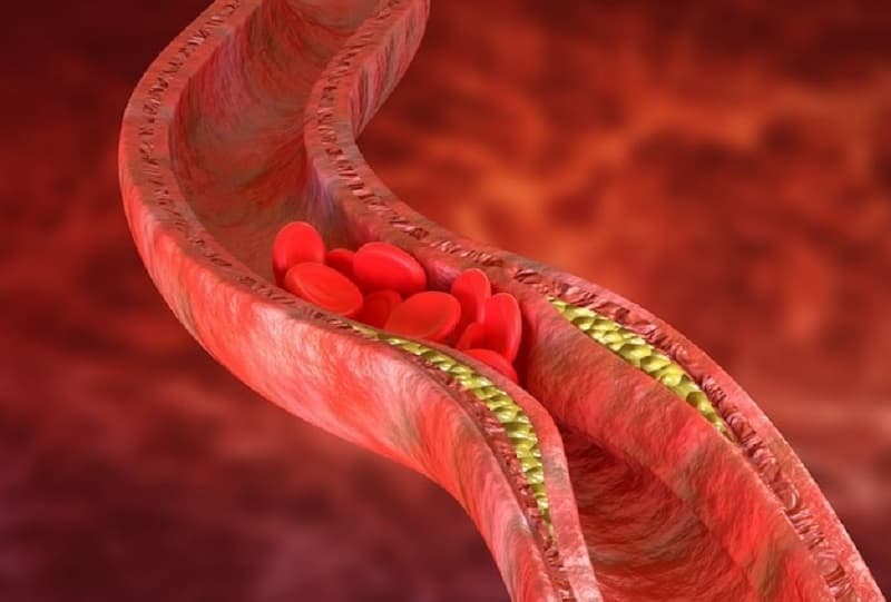 Không phải người nào cũng cần làm toàn bộ xét nghiệm lipid chuyên sâu