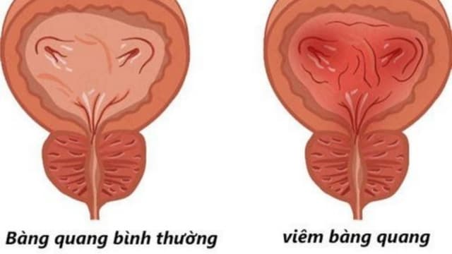 Tiểu ra máu bị gì? Có nguy hiểm không và phải làm sao?