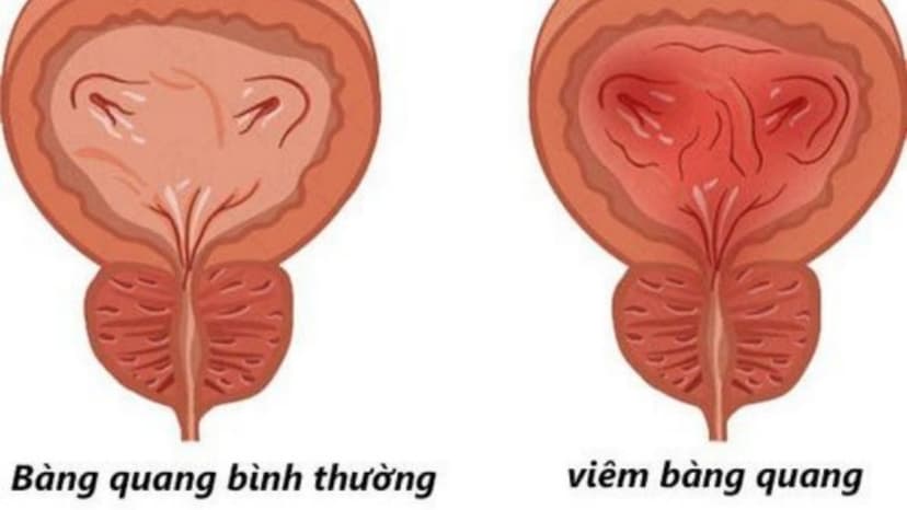 Tiểu ra máu bị gì? Có nguy hiểm không và phải làm sao?