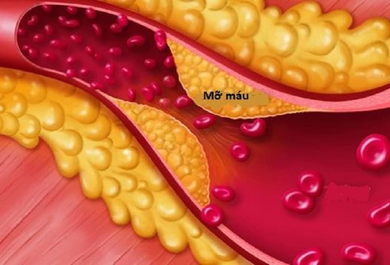 CDC cho biết cholesterol cao thường không có triệu chứng và xét nghiệm máu là cách để biết các chỉ số lipid có bất thường hay không