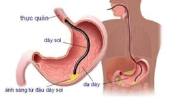 Trước khi nội soi tiêu hóa có phải nhịn ăn không?
