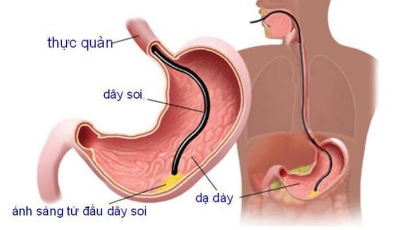 Trước khi nội soi tiêu hóa có phải nhịn ăn không?