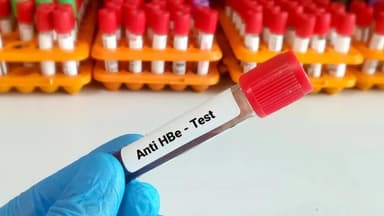 Xét nghiệm Anti HBe là gì?