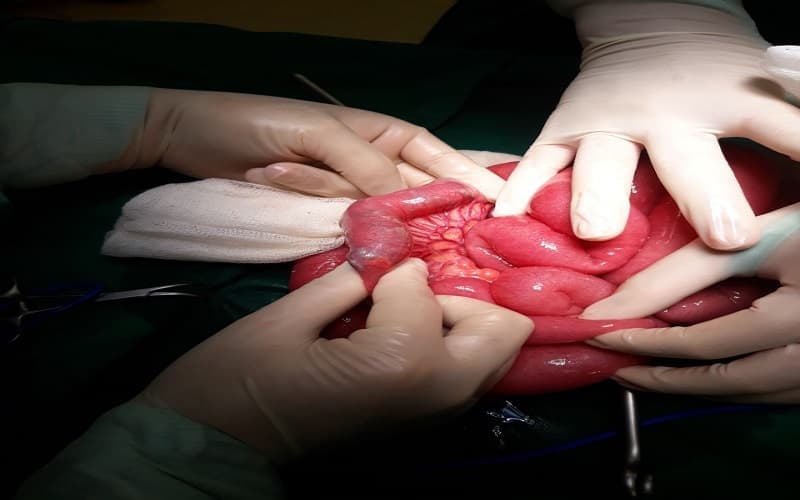 Tắc ruột do khối bã thức ăn gây cản trở lưu thông trong ruột