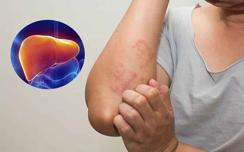 Ngứa da kéo dài có thể liên quan đến tình trạng ứ mật do bệnh gan