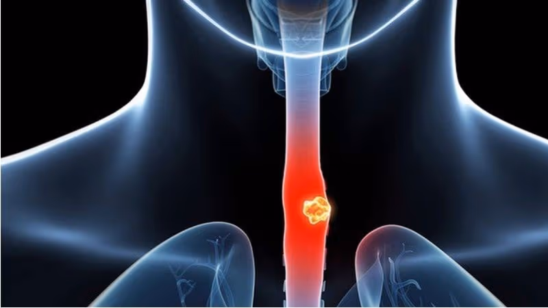 Bản thân hiện tượng Barrett thực quản không gây ra triệu chứng đặc hiệu nào