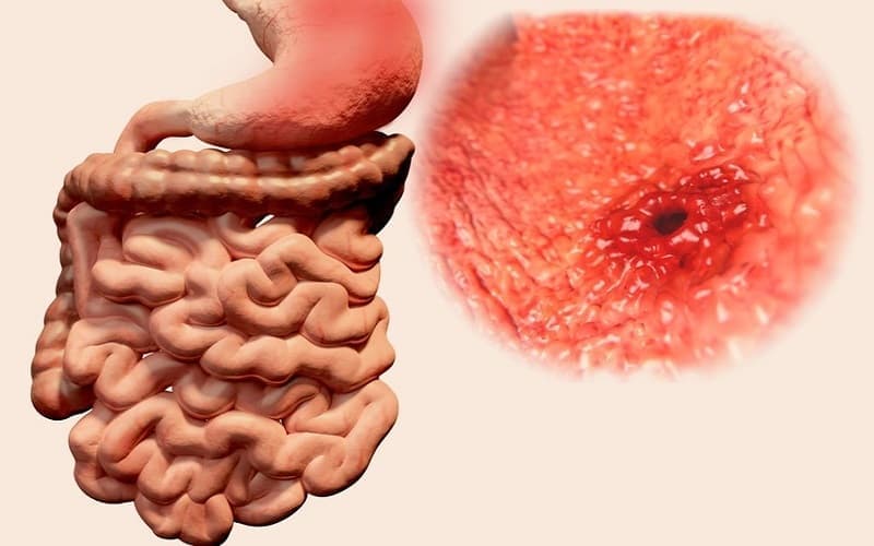 Bệnh Crohn gây ra nhiều triệu chứng ảnh hưởng đến sức khỏe và sinh hoạt của người bệnh
