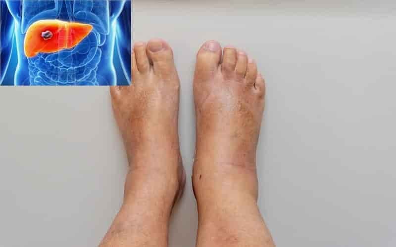 Bệnh gan tiến triển có thể gây phù chân, cổ trướng